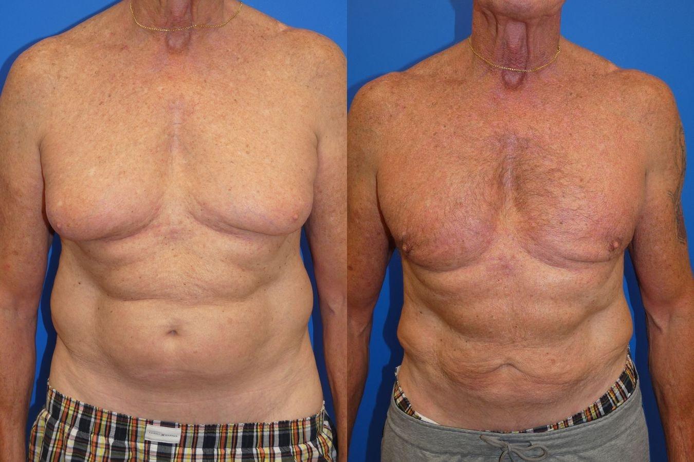 Palms Wellington Plastic Surgery (Itzhak Nir, MD) liposuction result — Loxahatchee, FL