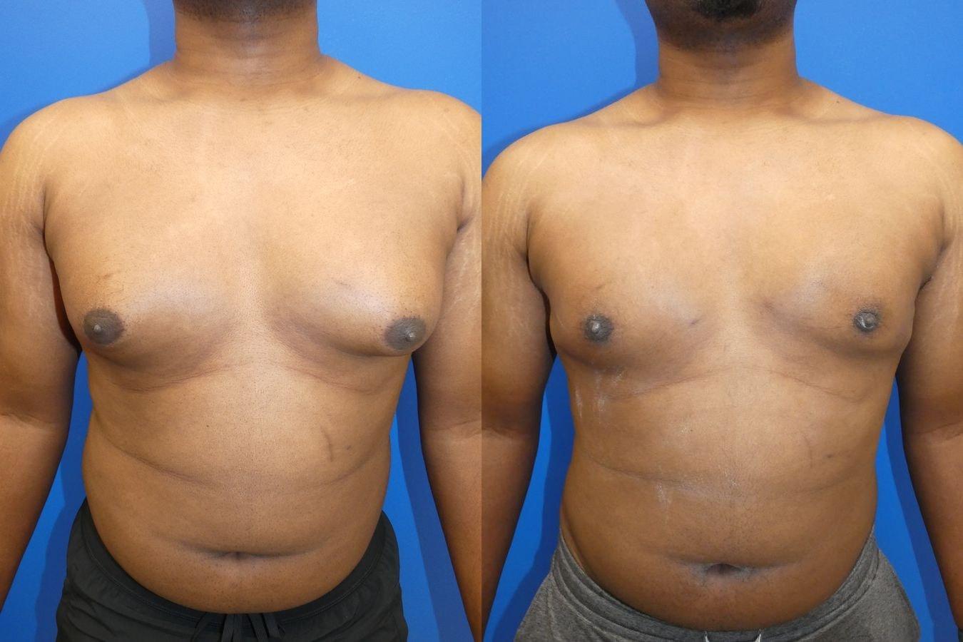 Palms Wellington Plastic Surgery (Itzhak Nir, MD) liposuction result — Loxahatchee, FL