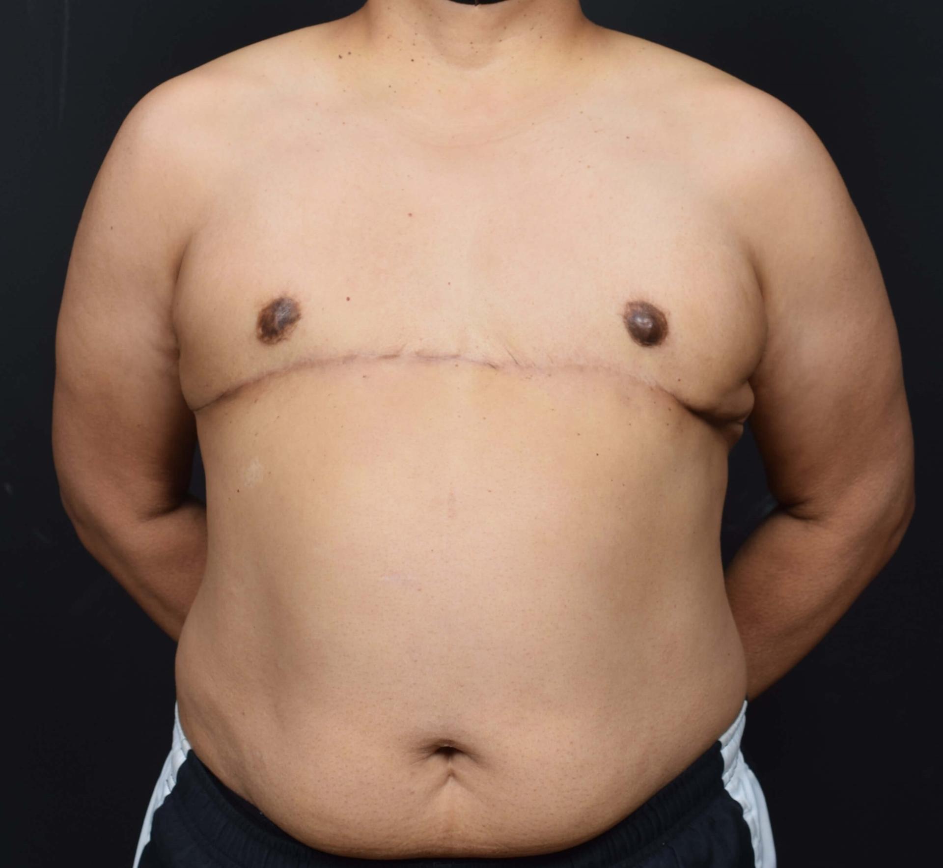 Sean McNally, MD Plastic Surgery gender affirming top surgery after — Portland, OR