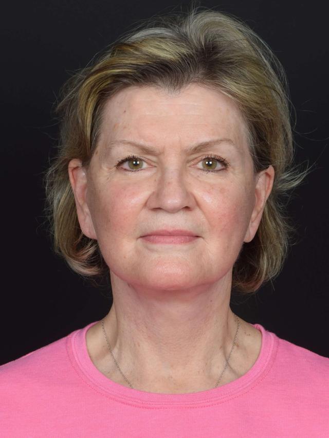 Neck Lift after at Sean McNally, MD Plastic Surgery in Portland, OR