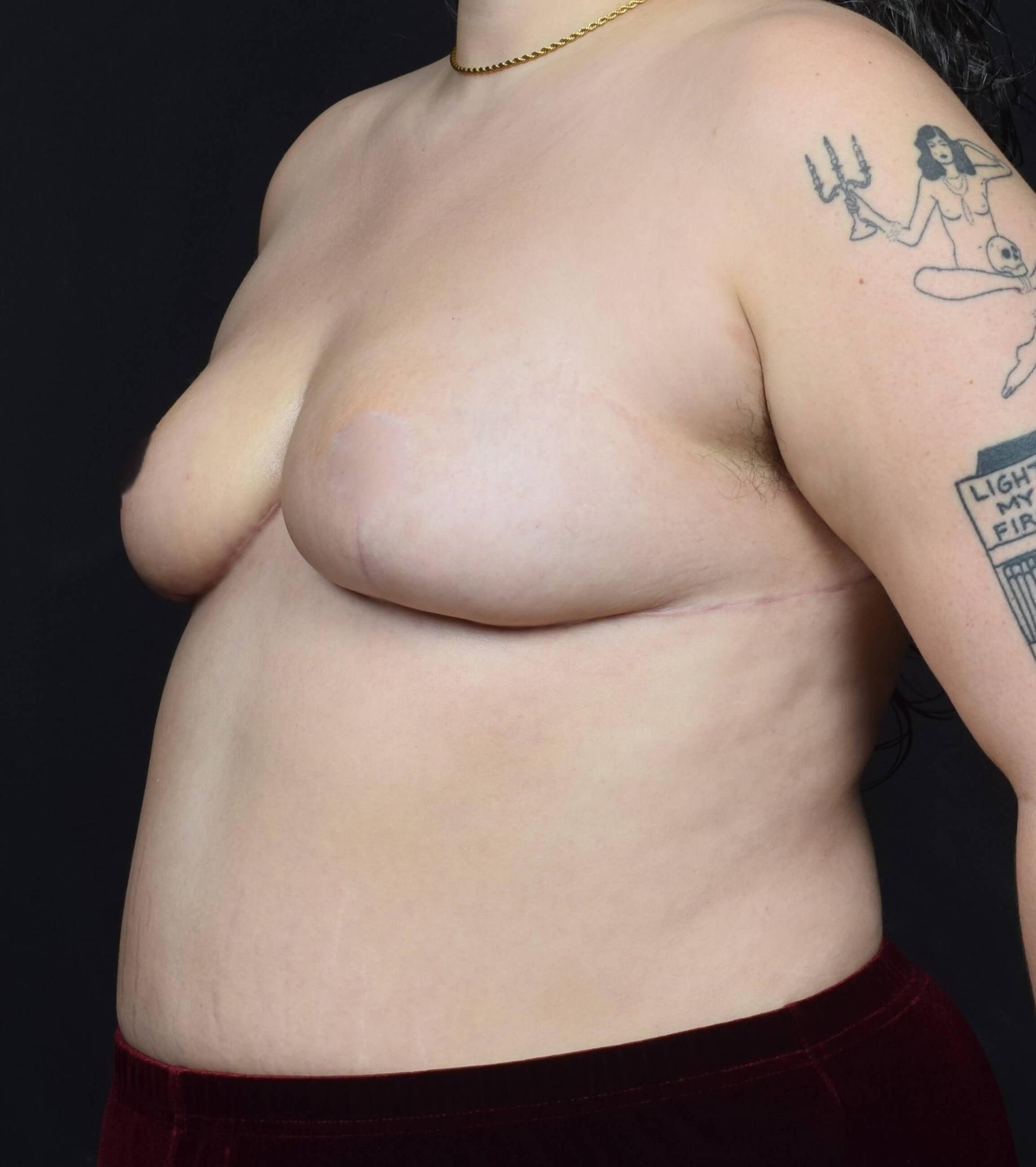Sean McNally, MD Plastic Surgery breast reduction after — Portland, OR
