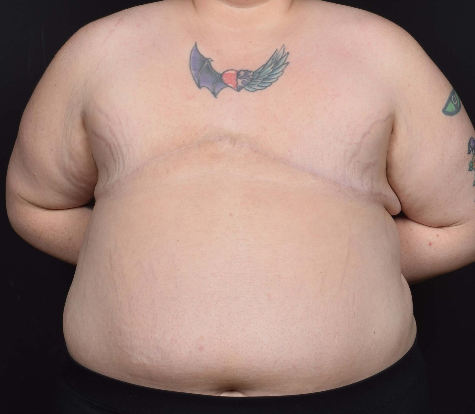 Sean McNally, MD Plastic Surgery gender affirming top surgery after — Portland, OR