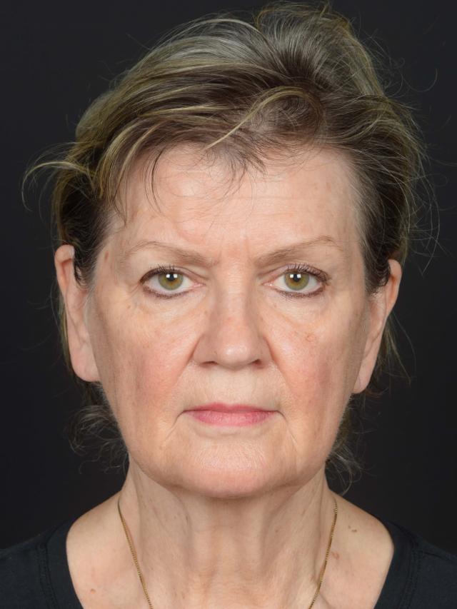Neck Lift before at Sean McNally, MD Plastic Surgery in Portland, OR