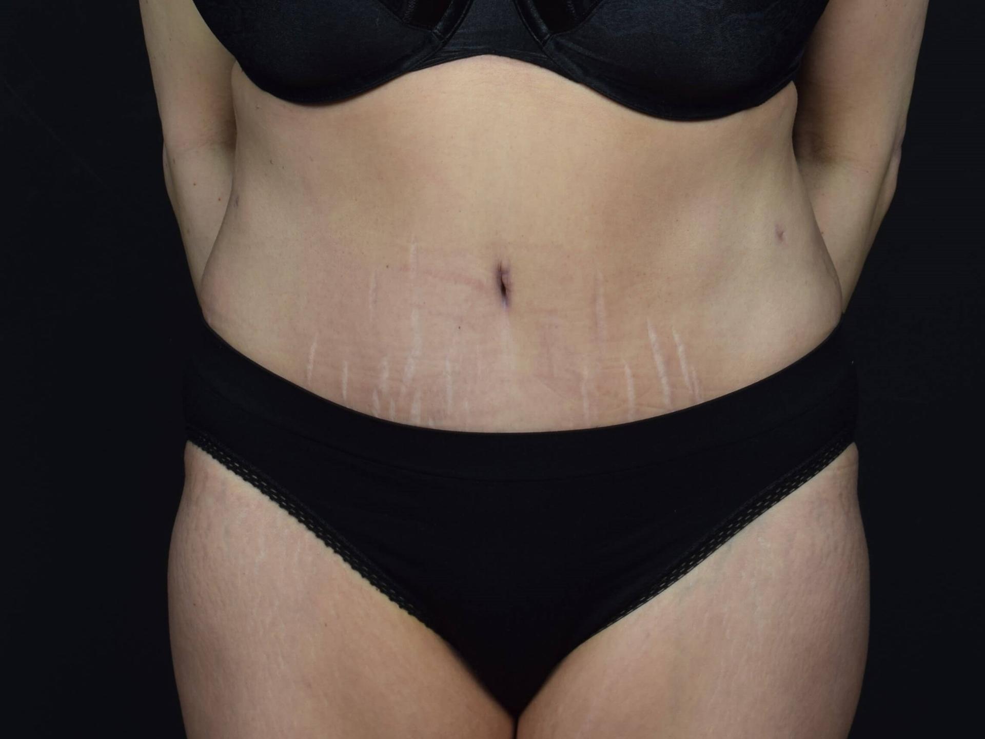 Sean McNally, MD Plastic Surgery tummy tuck after — Portland, OR