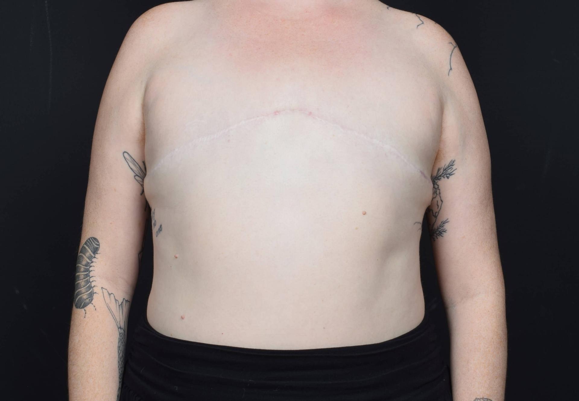 Sean McNally, MD Plastic Surgery gender affirming top surgery after — Portland, OR