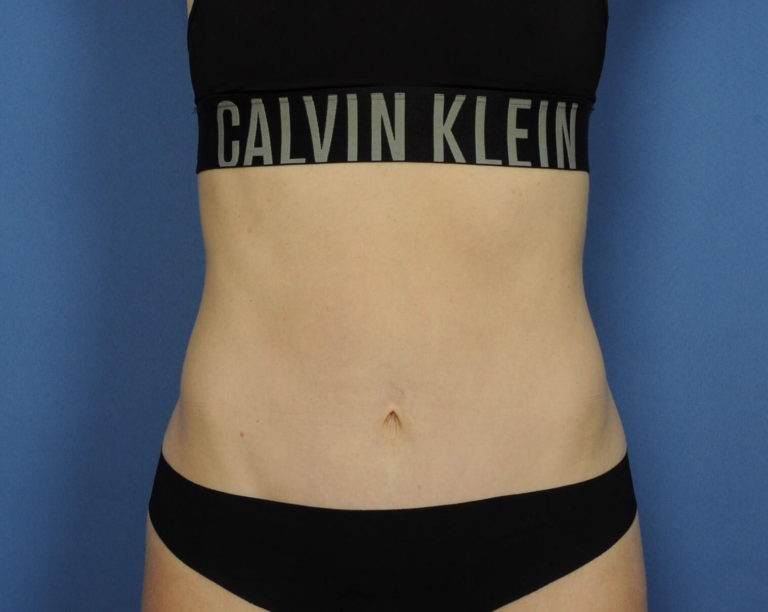 Sean McNally, MD Plastic Surgery tummy tuck after — Portland, OR