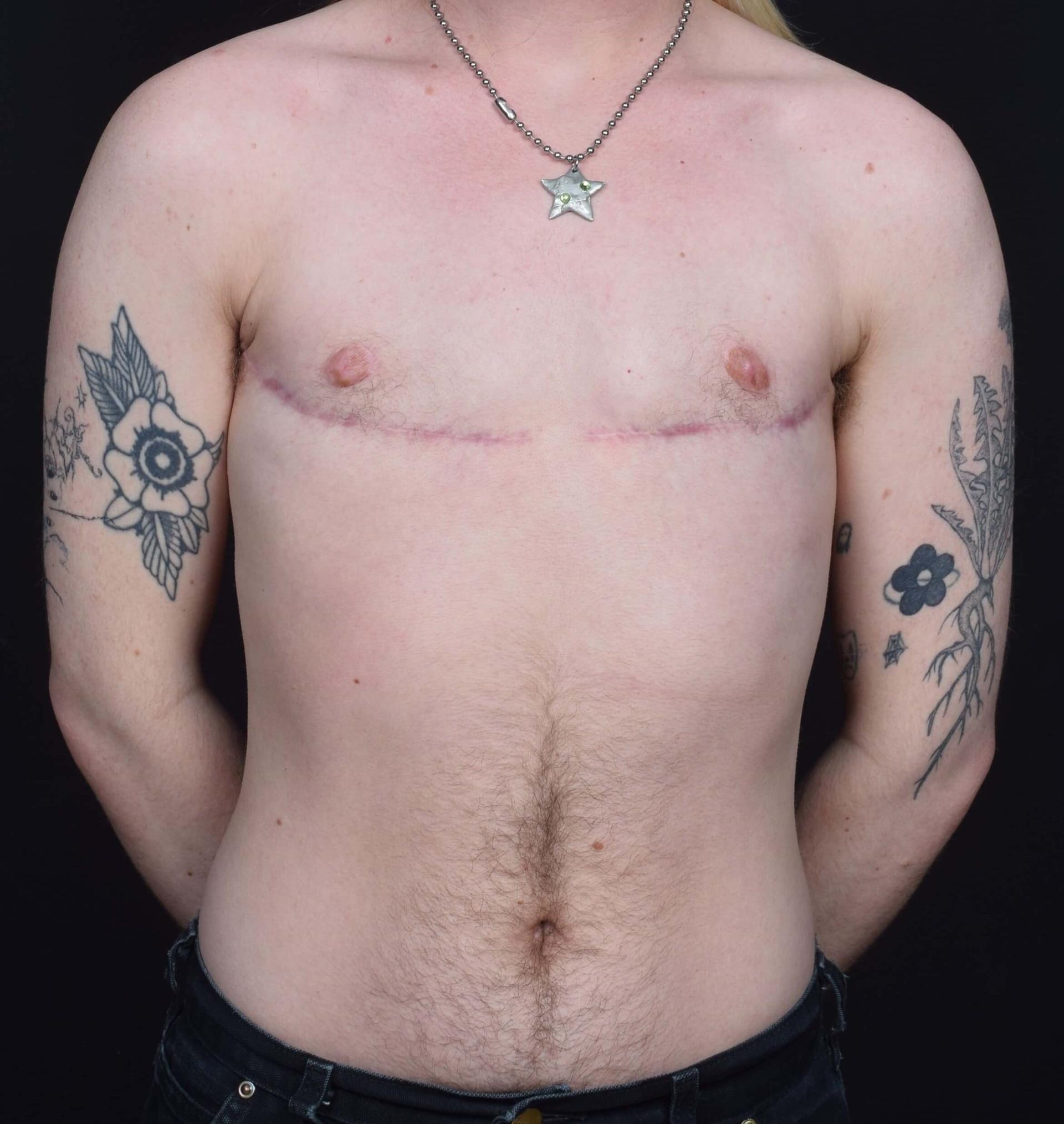 Sean McNally, MD Plastic Surgery gender affirming top surgery after — Portland, OR