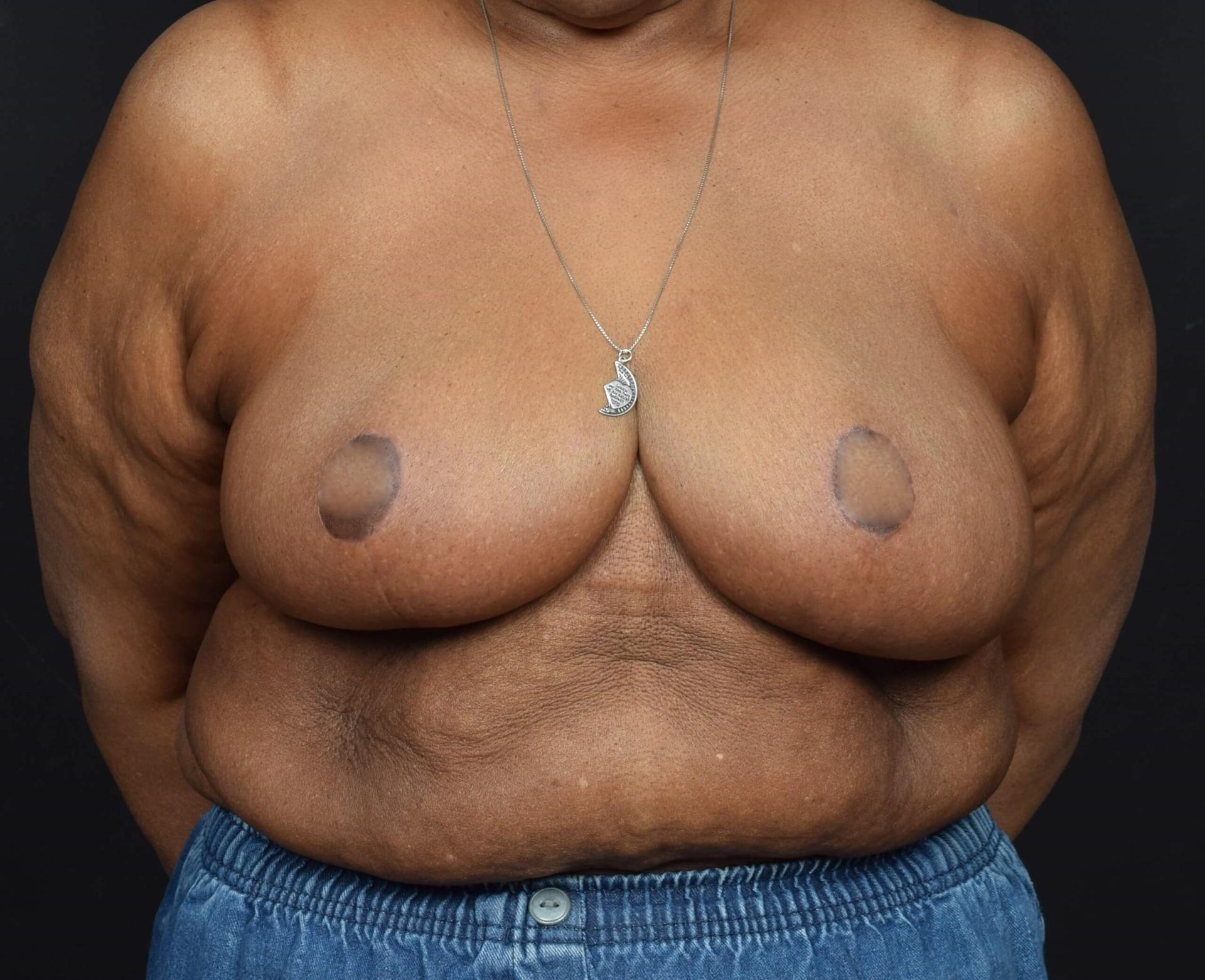 Sean McNally, MD Plastic Surgery breast reduction after — Portland, OR