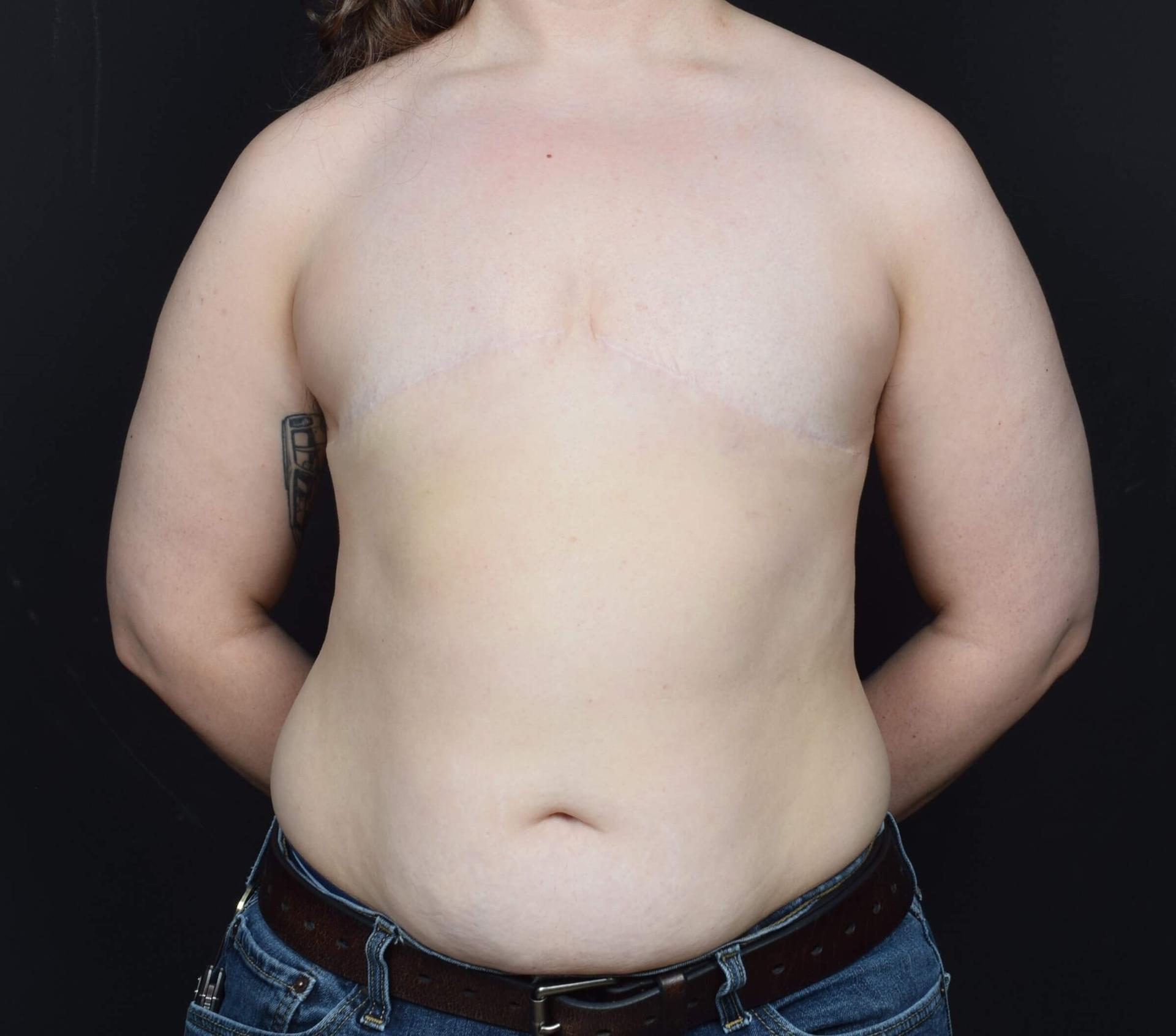 Sean McNally, MD Plastic Surgery gender affirming top surgery after — Portland, OR