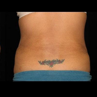 Lam Plastic Surgery liposuction after — Langhorne, PA