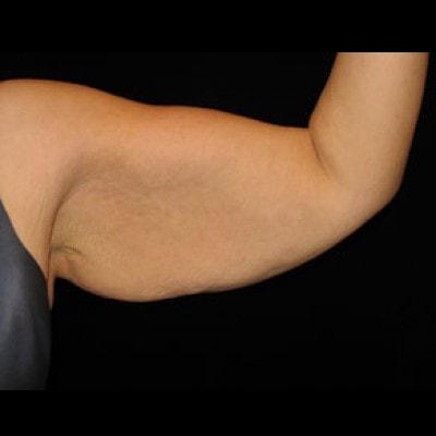 Lam Plastic Surgery arm lift after — Langhorne, PA