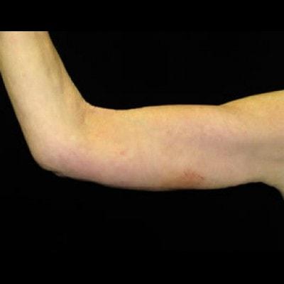 Lam Plastic Surgery arm lift after — Langhorne, PA