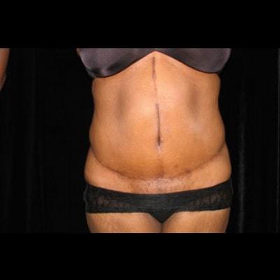 Lam Plastic Surgery tummy tuck after — Langhorne, PA
