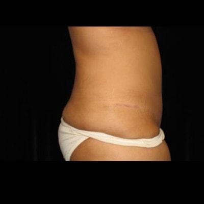 Lam Plastic Surgery tummy tuck after — Langhorne, PA