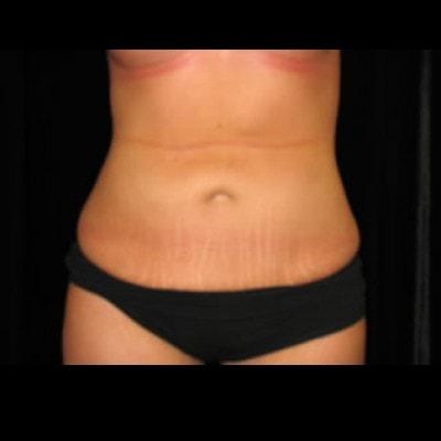 Lam Plastic Surgery liposuction after — Langhorne, PA