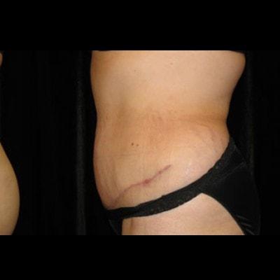 Lam Plastic Surgery tummy tuck after — Langhorne, PA