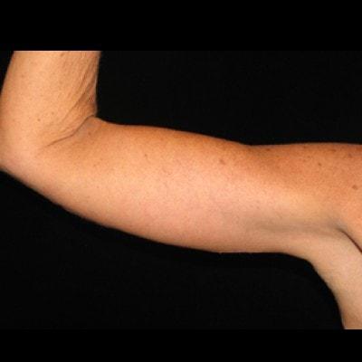 Lam Plastic Surgery arm lift after — Langhorne, PA