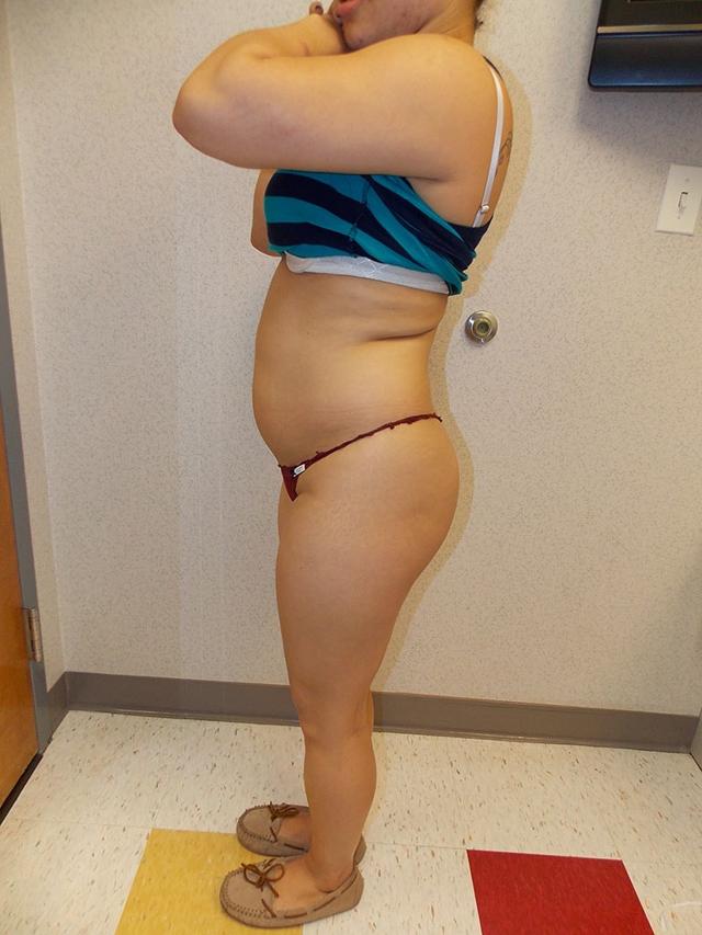 Brazilian Butt Lift before at Gabay & Gottlieb Cosmetic Surgery Center in Philadelphia, PA