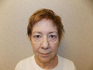 Blepharoplasty before at Gabay & Gottlieb Cosmetic Surgery Center in Philadelphia, PA