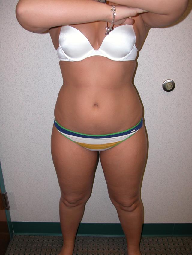 Brazilian Butt Lift before at Gabay & Gottlieb Cosmetic Surgery Center in Philadelphia, PA