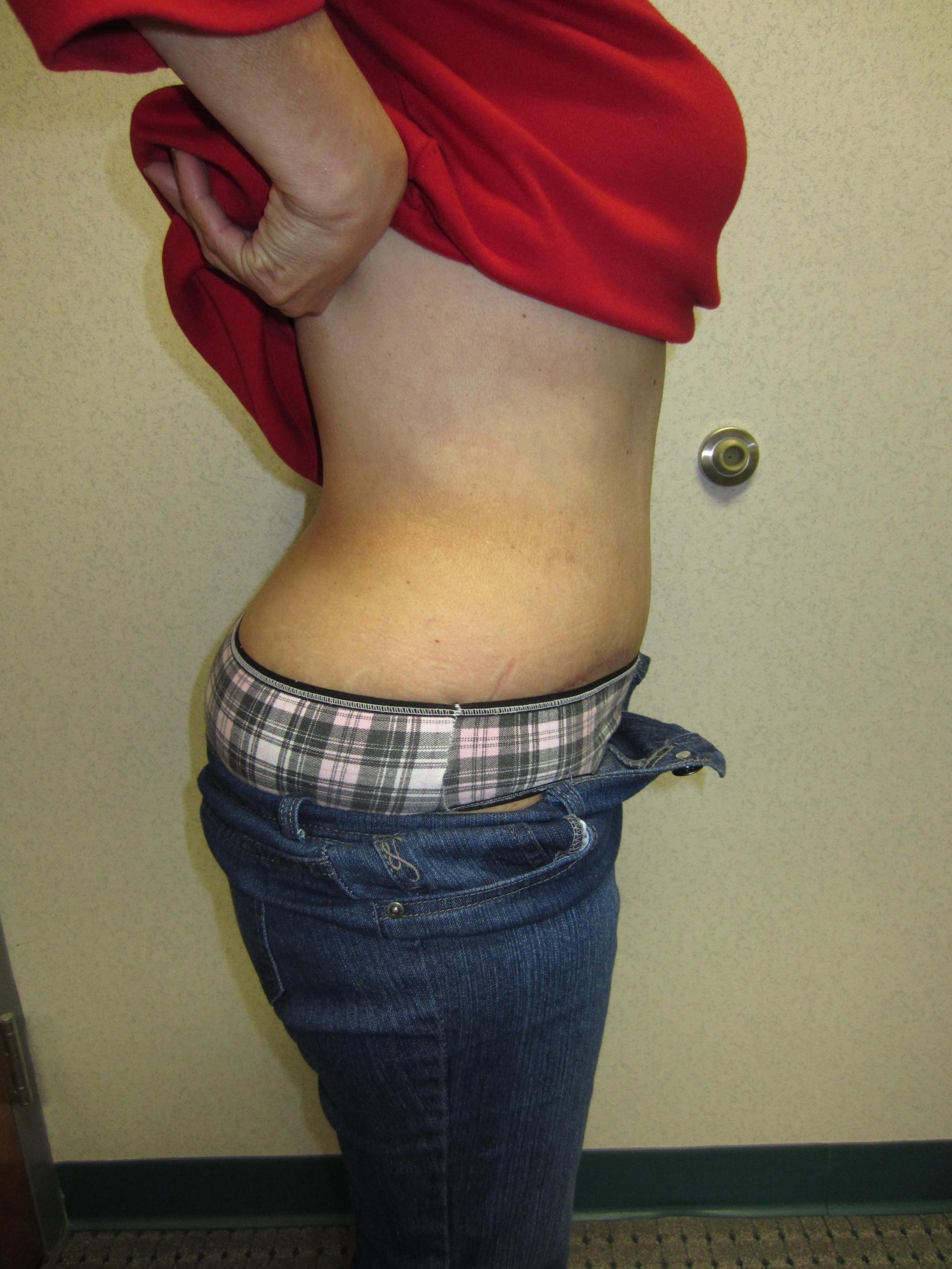 Gabay & Gottlieb Cosmetic Surgery Center tummy tuck after — Philadelphia, PA