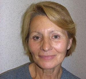Blepharoplasty after at Gabay & Gottlieb Cosmetic Surgery Center in Philadelphia, PA