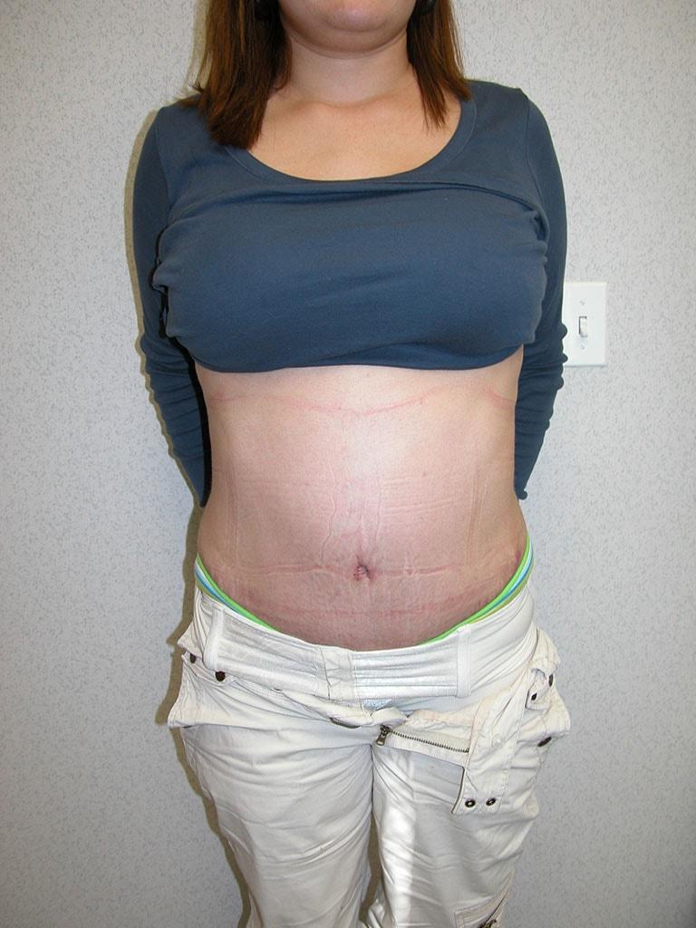 Gabay & Gottlieb Cosmetic Surgery Center tummy tuck after — Philadelphia, PA