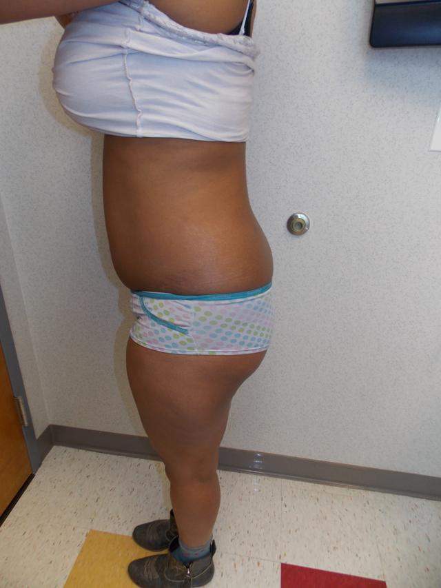 Brazilian Butt Lift before at Gabay & Gottlieb Cosmetic Surgery Center in Philadelphia, PA