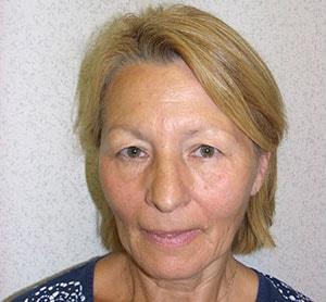 Blepharoplasty before at Gabay & Gottlieb Cosmetic Surgery Center in Philadelphia, PA