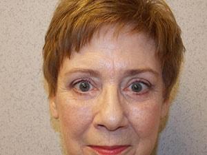 Blepharoplasty after at Gabay & Gottlieb Cosmetic Surgery Center in Philadelphia, PA