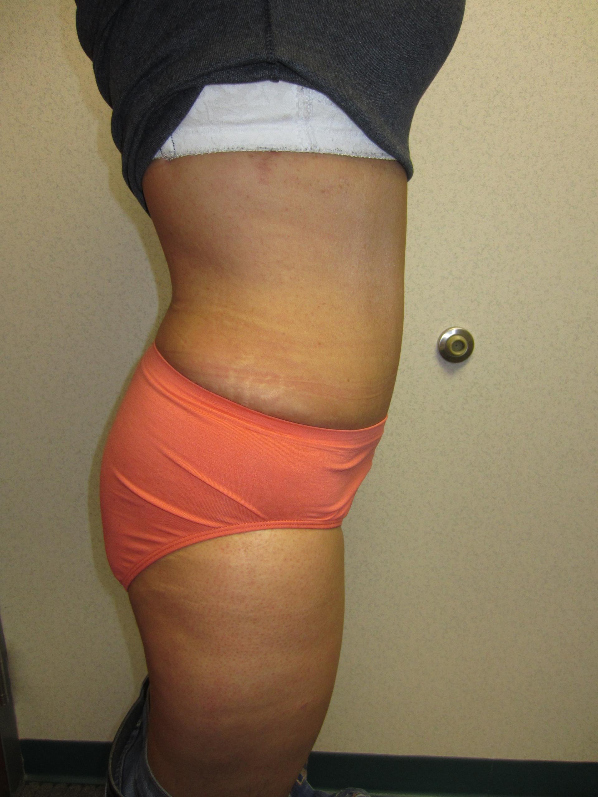 Gabay & Gottlieb Cosmetic Surgery Center tummy tuck after — Philadelphia, PA