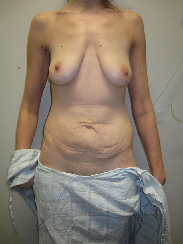 Mommy Makeover before at Gabay & Gottlieb Cosmetic Surgery Center in Philadelphia, PA