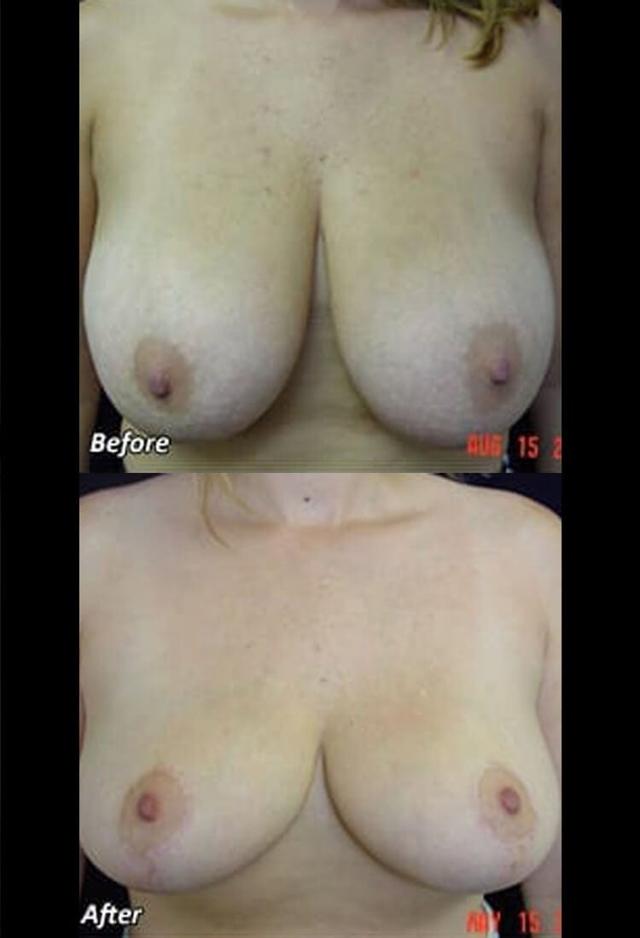 Breast Reduction result at West Plano Plastic Surgery Center in Plano, TX