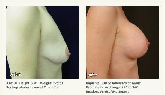 West Plano Plastic Surgery Center result — Plano, TX
