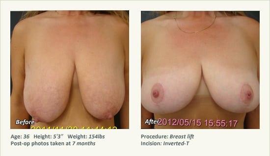Breast Lift result at West Plano Plastic Surgery Center in Plano, TX