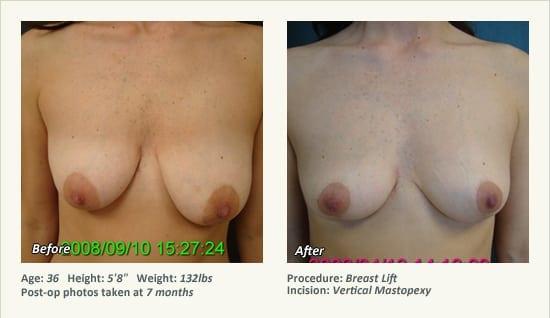 Breast Lift result at West Plano Plastic Surgery Center in Plano, TX