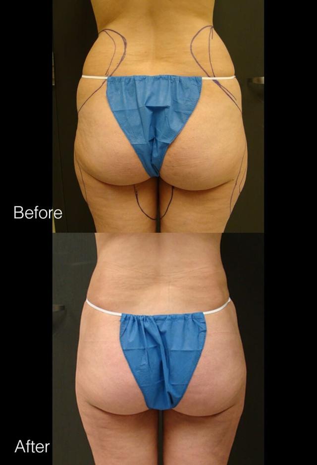 Liposuction result at West Plano Plastic Surgery Center in Plano, TX