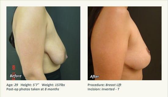 Breast Lift result at West Plano Plastic Surgery Center in Plano, TX