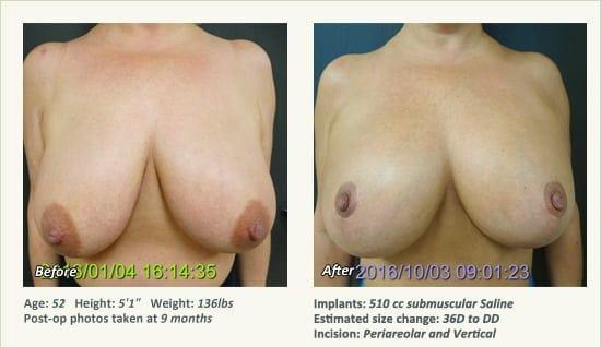 Breast Augmentation result at West Plano Plastic Surgery Center in Plano, TX