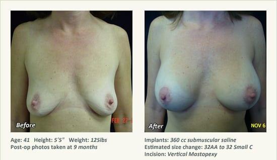 West Plano Plastic Surgery Center result — Plano, TX