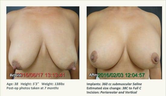 Breast Augmentation result at West Plano Plastic Surgery Center in Plano, TX