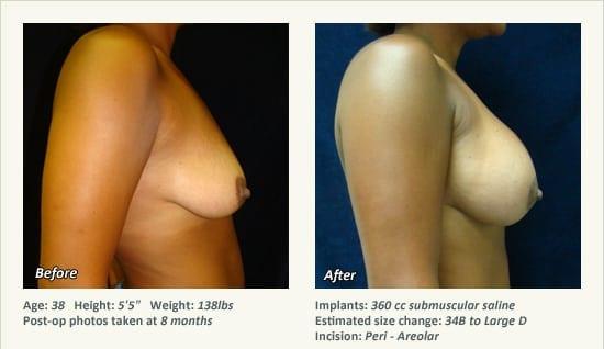 West Plano Plastic Surgery Center result — Plano, TX