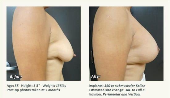 Breast Augmentation result at West Plano Plastic Surgery Center in Plano, TX