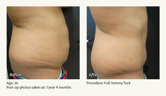 Tummy Tuck result at West Plano Plastic Surgery Center in Plano, TX