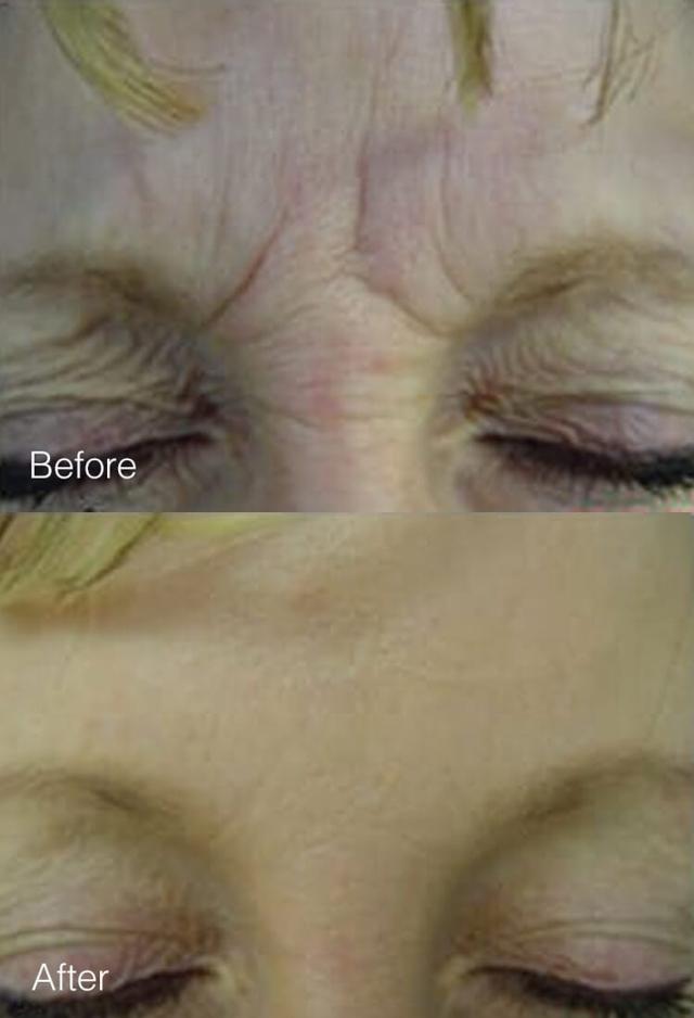 Botox result at West Plano Plastic Surgery Center in Plano, TX