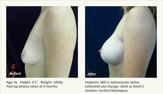 West Plano Plastic Surgery Center result — Plano, TX