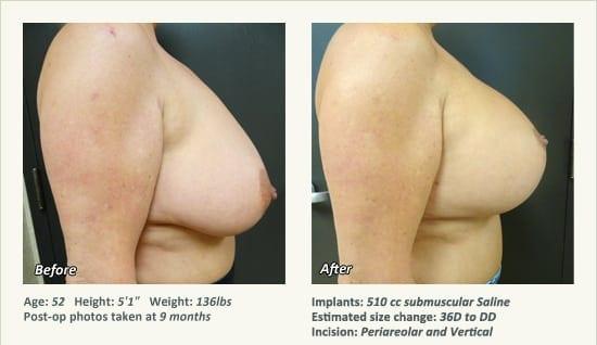 Breast Lift result at West Plano Plastic Surgery Center in Plano, TX