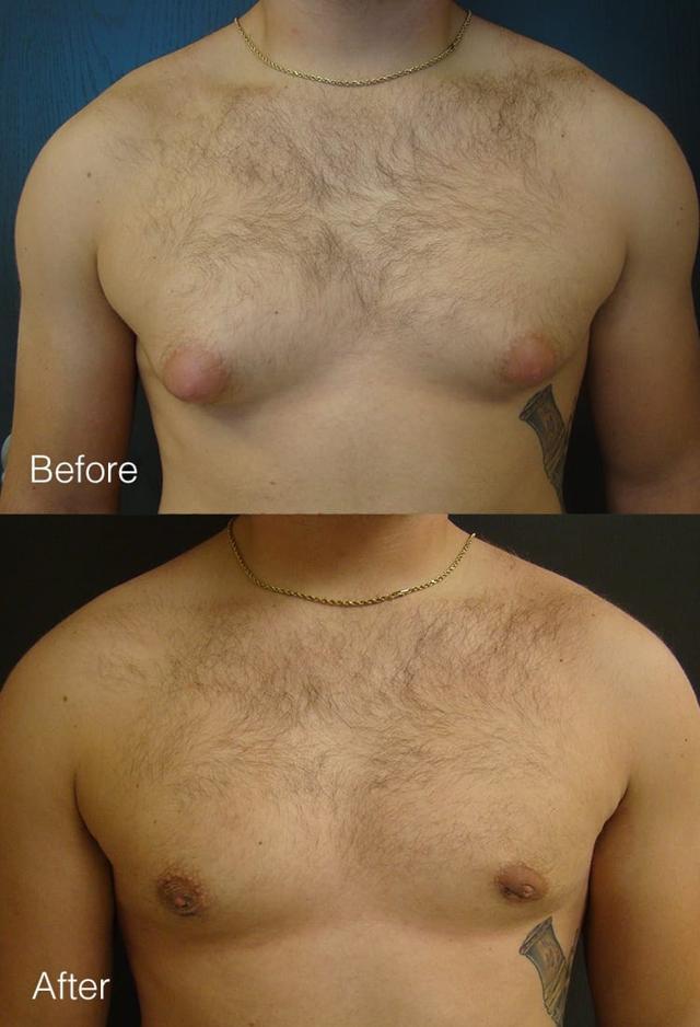 Gynecomastia Surgery result at West Plano Plastic Surgery Center in Plano, TX