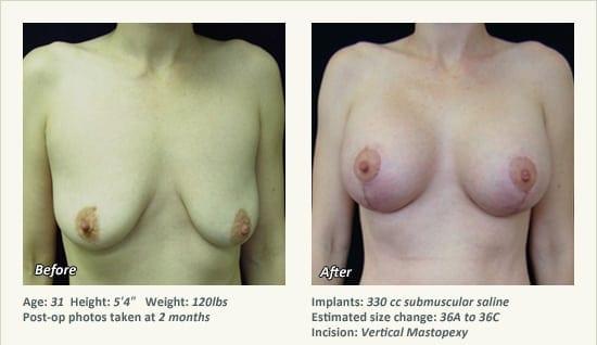 West Plano Plastic Surgery Center result — Plano, TX
