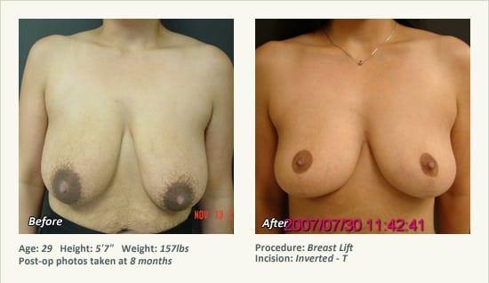 Breast Lift result at West Plano Plastic Surgery Center in Plano, TX